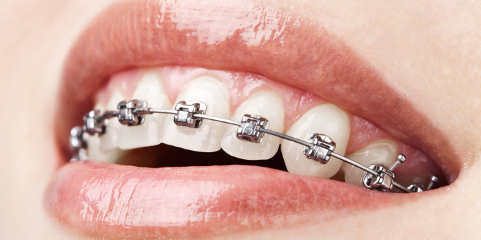 metal braces